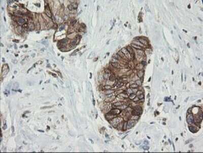 Immunohistochemistry: Tapasin Related Protein Antibody (OTI4H5) - Azide and BSA Free [NBP2-74443] - Analysis of Adenocarcinoma of Human colon tissue. (Heat-induced epitope retrieval by 10mM citric buffer, pH6.0, 120C for 3min)