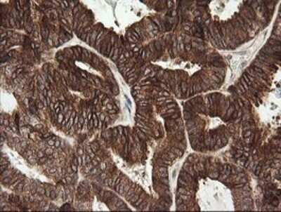 Immunohistochemistry: Tapasin Related Protein Antibody (OTI4H5) - Azide and BSA Free [NBP2-74443] - Analysis of Adenocarcinoma of Human endometrium tissue. (Heat-induced epitope retrieval by 10mM citric buffer, pH6.0, 120C for 3min)