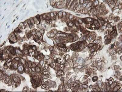 Immunohistochemistry: Tapasin Related Protein Antibody (OTI4H5) - Azide and BSA Free [NBP2-74443] - Analysis of Adenocarcinoma of Human ovary tissue. (Heat-induced epitope retrieval by 10mM citric buffer, pH6.0, 120C for 3min)