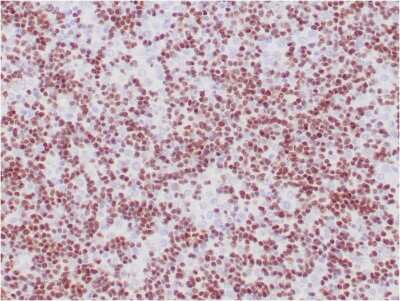 Immunohistochemistry-Paraffin: TdT Antibody (TDT/1393) - Azide and BSA Free [NBP3-08484] - Formalin-fixed, paraffin-embedded human thymoma stained with TdT Antibody (TDT/1393).