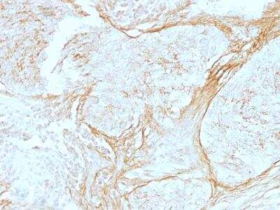 Immunohistochemistry-Paraffin: Tenascin C Antibody (SPM319) - IHC-Prediluted [NBP2-48457] - Formalin-fixed, paraffin-embedded human Lung Carcinoma stained with Tenascin C Mouse Monoclonal Antibody (SPM319).