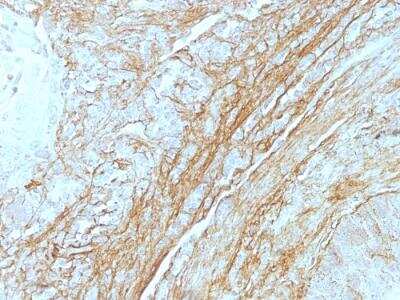 Immunohistochemistry-Paraffin: Tenascin C Antibody (T2H5) - IHC-Prediluted [NBP2-48456] - Formalin-fixed, paraffin-embedded human Lung Carcinoma stained with Tenascin C Monoclonal Antibody (T2H5). Note staining of connective tissue.