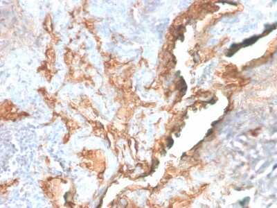 Immunohistochemistry-Paraffin: Tenascin C Antibody (TNC/2981R) - Azide and BSA Free [NBP3-08946] - Formalin-fixed, paraffin-embedded human Lung Carcinoma stained with Tenascin C Rabbit Recombinant Monoclonal Antibody (TNC/2981R).