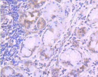 Immunohistochemistry-Paraffin: TfR (Transferrin R) Antibody (JF0956) [NBP2-67189] - Analysis of paraffin-embedded human lung cancer tissue using anti-Transferrin Receptor antibody. Counter stained with hematoxylin.