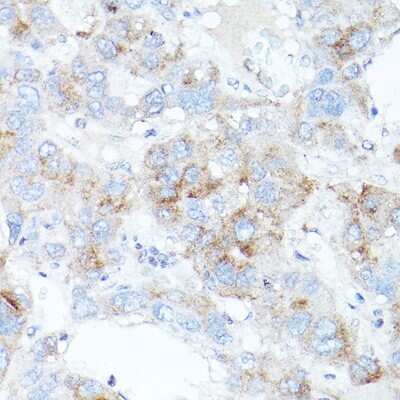 Immunohistochemistry-Paraffin: TfR2 Antibody [NBP2-93436] - Immunohistochemistry of paraffin-embedded human liver cancer using TfR2 antibody (NBP2-93436) at dilution of 1:100 (40x lens). Perform high pressure antigen retrieval with 10 mM citrate buffer pH 6.0 before commencing with IHC staining protocol.