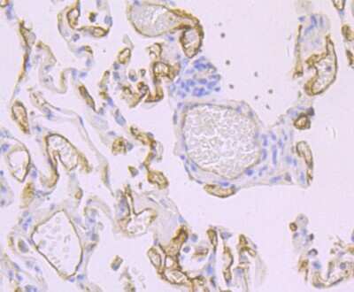 Immunohistochemistry-Paraffin: Thrombomodulin/BDCA-3 Antibody (JB48-23) [NBP2-75683] - Analysis of paraffin-embedded human lung cancer tissue using anti-Thrombomodulin antibody. Counter stained with hematoxylin.