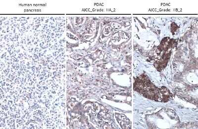 <b>Biological Strategies Validation. </b>Immunohistochemistry-Paraffin: Thrombospondin-2 Antibody (GT147) [NBP3-13654] - Thrombospondin-2 antibody [GT147] detects Thrombospondin-2 protein at cell membrane and cytoplasm by immunohistochemical analysis. Sample: Paraffin-embedded human pancreas (left) and pancreatic ductal adenocarcinoma (middle and right). Thrombospondin-2 stained by Thrombospondin-2 antibody [GT147] (NBP3-13654) diluted at 1:500. Antigen Retrieval: Citrate buffer, pH 6.0, 15 min