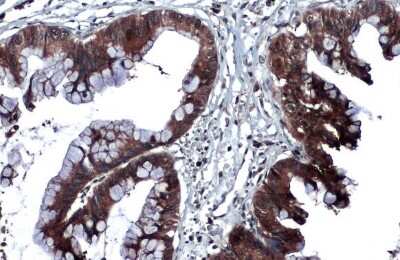 Immunohistochemistry-Paraffin: Thrombospondin-2 Antibody [NBP3-13398] - Thrombospondin-2 antibody detects Thrombospondin-2 protein at cytoplasm by immunohistochemical analysis. Sample: Paraffin-embedded human pancreatic cancer. Thrombospondin-2 stained by Thrombospondin-2 antibody (NBP3-13398) diluted at 1:1000. Antigen Retrieval: Citrate buffer, pH 6.0, 15 min