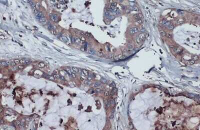 Immunohistochemistry-Paraffin: Thrombospondin-2 Antibody [NBP3-13398] - Thrombospondin-2 antibody detects Thrombospondin-2 protein at cytoplasm by immunohistochemical analysis. Sample: Paraffin-embedded human pancreatic cancer. Thrombospondin-2 stained by Thrombospondin-2 antibody (NBP3-13398) diluted at 1:1000. Antigen Retrieval: Citrate buffer, pH 6.0, 15 min