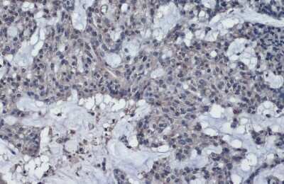 <b>Biological Strategies Validation. </b>Immunohistochemistry-Paraffin: Thrombospondin-2 Antibody [NBP3-13399] - Thrombospondin-2 antibody detects Thrombospondin-2 protein at cytoplasm by immunohistochemical analysis. Sample: Paraffin-embedded human breast carcinoma. Thrombospondin-2 stained by Thrombospondin-2 antibody (NBP3-13399) diluted at 1:1000. Antigen Retrieval: Citrate buffer, pH 6.0, 15 min