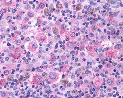 Immunohistochemistry-Paraffin: Thromboxane A2 R/TBXA2R Antibody [NLS1280] - Analysis of anti-TBXA2R antibody with human skin, melanoma.