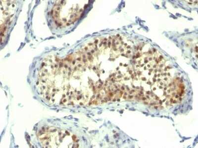 Immunohistochemistry-Paraffin: Thymidylate Synthase Antibody (TMS715) [NBP2-34446] - Formalin-fixed, paraffin-embedded human Testicular Carcinoma stained with Thymidylate Synthase Antibody (TMS715).