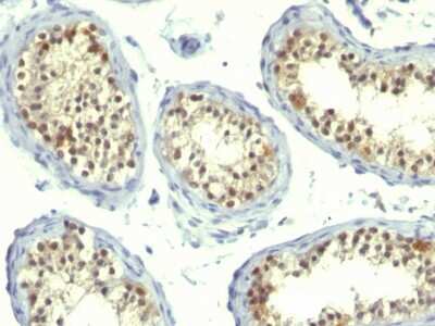 Immunohistochemistry-Paraffin: Thymidylate Synthase Antibody (TS106 + TMS715) - Azide and BSA Free [NBP2-34503] - Formalin-fixed, paraffin-embedded human Testicular Carcinoma stained with Thymidylate Synthase Antibody (TS106 + TMS715).