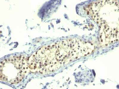 Immunohistochemistry-Paraffin: Thymidylate Synthase Antibody (TS106) - Azide and BSA Free [NBP2-34502] - Formalin-fixed, paraffin-embedded human Testicular Carcinoma stained with Thymidylate Synthase Antibody (TS106).