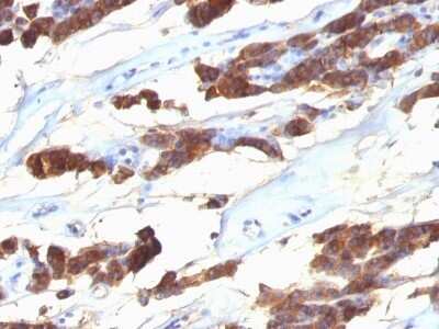 Immunohistochemistry-Paraffin: Thyroglobulin Antibody (SPM221) - Azide and BSA Free [NBP2-34748] - Formalin-fixed, paraffin-embedded human Thyroid Carcinoma stained with Thyroglobulin Antibody (SPM221).