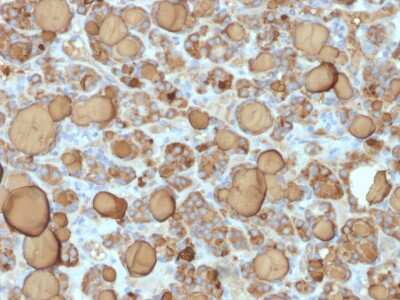 Immunohistochemistry-Paraffin: Thyroglobulin Antibody (TGB/1968R) - Azide and BSA Free [NBP3-08269] - Formalin-fixed, paraffin-embedded human Thyroid Carcinoma stained with Thyroglobulin Rabbit Recombinant Monoclonal Antibody (TGB/1968R).