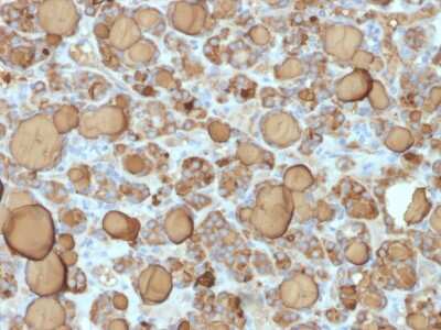 Immunohistochemistry-Paraffin: Thyroglobulin Antibody (TGB/1968R) [NBP3-07353] - Formalin-fixed, paraffin-embedded human Thyroid Carcinoma stained with Thyroglobulin Rabbit Recombinant Monoclonal Antibody (TGB/1968R).