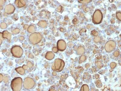 Immunohistochemistry-Paraffin: Thyroglobulin Antibody (TGB/1970R) - Azide and BSA Free [NBP3-08265] - Formalin-fixed, paraffin-embedded human Thyroid stained with Thyroglobulin Rabbit Recombinant Monoclonal Antibody (TGB/1970R).