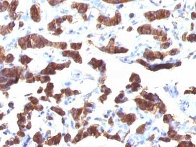 Immunohistochemistry-Paraffin: Thyroglobulin Antibody (TGB24) [NBP2-45123] - Human Thyroid Carcinoma stained with Thyroglobulin Monoclonal Antibody (TGB24).