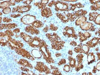 Immunohistochemistry-Paraffin: Thyroid Peroxidase Antibody (TPO/1922) - Azide and BSA Free [NBP2-79923] - Formalin-fixed, paraffin-embedded human Thyroid Carcinoma stained with Thyroid Peroxidase Mouse Monoclonal Antibody (TPO/1922).