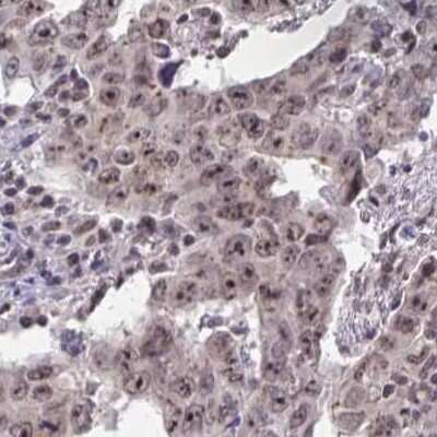Immunohistochemistry: Thyroid receptor-interacting protein 12 Antibody [NBP2-33450] - Staining of testis cancer.