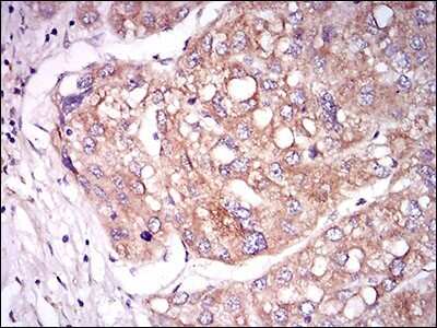 Immunohistochemistry: Tie-1 Antibody (8D12B10) [NBP2-37270] - Immunohistochemical analysis of paraffin-embedded liver cancer tissues using TIE1 mouse mAb with DAB staining.