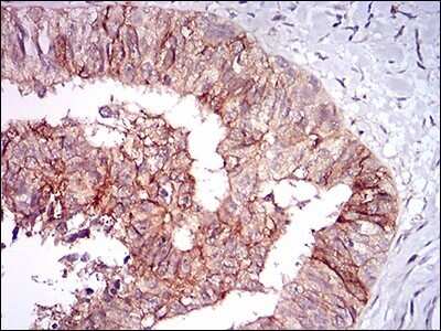 Immunohistochemistry: Tie-1 Antibody (8D12D2) [NBP2-37267] - Immunohistochemical analysis of paraffin-embedded ovarian cancer tissues using TIE1 mouse mAb with DAB staining.