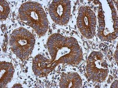 Immunohistochemistry-Paraffin: Tie-1 Antibody [NBP2-20635] - Human colon carcinoma, using TIE1 antibody at 1:500 dilution. Antigen Retrieval: Trilogy™ (EDTA based, pH 8.0) buffer, 15min.