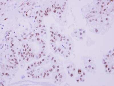 Immunohistochemistry-Paraffin: TOP2B Antibody [NBP2-20684] - Ovarian cancer, using Topoisomerase II beta antibody at 1:250 dilution.  Antigen Retrieval: Trilogy™ (EDTA based, pH 8.0) buffer, 15min. 