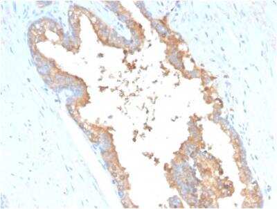 Immunohistochemistry-Paraffin: Transferrin Antibody (TF/3001) - Azide and BSA Free [NBP2-79912] - Formalin-fixed, paraffin-embedded human Prostate Carcinoma stained with Transferrin Mouse Monoclonal Antibody (TF/3001).