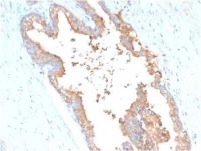 Immunohistochemistry-Paraffin: Transferrin Antibody (TF/3001) [NBP2-79778] - Formalin-fixed, paraffin-embedded human Prostate Carcinoma stained with Transferrin Antibody (TF/3001).