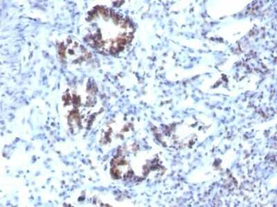 Immunohistochemistry-Paraffin: Transgelin/TAGLN/SM22 alpha Antibody (SPM606) - IHC-Prediluted [NBP2-48074] - Human Colon Carcinoma stained with Transgelin Monoclonal Antibody (SPM606)