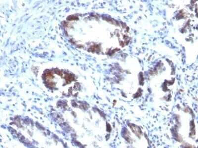 Immunohistochemistry-Paraffin: Transgelin/TAGLN/SM22 alpha Antibody (TAGLN/247) - IHC-Prediluted [NBP2-48073] - Human Colon Carcinoma stained with Transgelin Monoclonal Antibody (TAGLN/247)