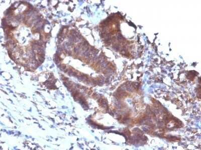 Immunohistochemistry-Paraffin: Transgelin/TAGLN/SM22 alpha Antibody (TAGLN/247) - IHC-Prediluted [NBP2-48073] - Human Colon Carcinoma stained with Transgelin Monoclonal Antibody (TAGLN/247)