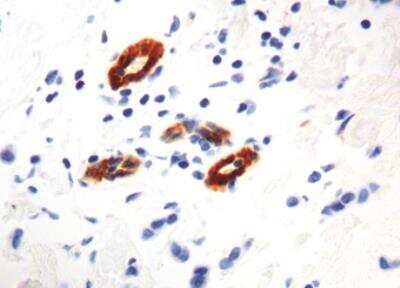Immunohistochemistry-Paraffin: Transglutaminase 2/TGM2 Antibody (CUB7402) [NBP2-26458] - Formalin fixed paraffin embedded breast carcinoma stained with Transglutaminase 2/TGM2 antibody (NBP2-26458).