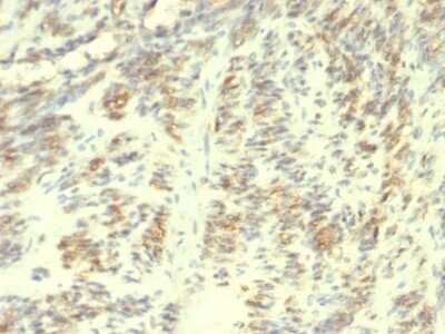 Immunohistochemistry-Paraffin: Transglutaminase 2/TGM2 Antibody (SPM358) - Azide and BSA Free [NBP2-47926] - Human Leiomyosarcoma stained with Transglutaminase II Monoclonal Antibody (TGM2/419)