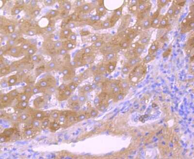 Immunohistochemistry-Paraffin: Transthyretin/Prealbumin Antibody (JM11-43) [NBP2-67227] - Analysis of paraffin-embedded human liver cancer tissue using anti-TTR antibody. Counter stained with hematoxylin.