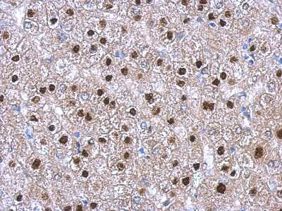 Immunohistochemistry-Paraffin: Trim11 Antibody [NBP2-20705] -  Human hepatoma, using RNF92 antibody at 1:500 dilution. Antigen Retrieval: Trilogy™ (EDTA based, pH 8.0) buffer, 15min. 