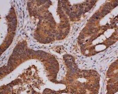 Immunohistochemistry-Paraffin: Troponin I Type 1 (slow skeletal) Antibody (OTI8H8) [NBP2-46170] - Human colorectal cancer tissue section stained with Troponin I Type 1 (slow skeletal) Antibody (OTI8H8). Incubation O/N at 4C with antibody at 1:200. IHC-P image submitted by a verified customer review.