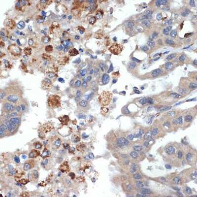 Immunohistochemistry-Paraffin: Trypsin 2/PRSS2 Antibody (3D9O7) [NBP3-15733] - Immunohistochemistry of paraffin-embedded human liver cancer using Trypsin 2/PRSS2 Rabbit mAb (NBP3-15733) at dilution of 1:100 (40x lens).Perform microwave antigen retrieval with 10 mM Tris/EDTA buffer pH 9.0 before commencing with IHC staining protocol.