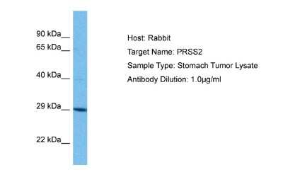 Western Blot: Trypsin 2/PRSS2 Antibody [NBP2-86879] - Host: Rabbit. Target Name: PRSS2. Sample Tissue: Human Stomach Tumor lysates. Antibody Dilution: 1ug/ml