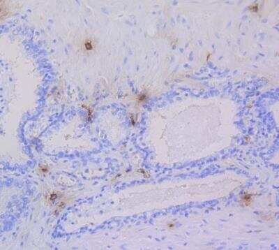 Immunohistochemistry-Paraffin: Tryptase alpha/TPS1 Antibody (SC68-07) [NBP2-67608] - Human prostate carcinoma tissue using anti-Mast Cell Tryptase antibody. The section was pre-treated using heat mediated antigen retrieval with Tris-EDTA buffer (pH 8.0-8.4) for 20 minutes.The tissues were blocked in 5% BSA for 30 minutes at room temperature, washed with ddH2O and PBS, and then probed with the primary antibody (1/50) for 30 minutes at room temperature. The detection was performed using an HRP conjugated compact polymer system. DAB was used as the chromogen. Tissues were counterstained with hematoxylin and mounted with DPX.