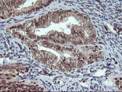 Immunohistochemistry-Paraffin: Tryptase gamma-1/TPSG1 Antibody (OTI1G1) - Azide and BSA Free [NBP2-74652] - Immunohistochemical staining of paraffin-embedded Adenocarcinoma of Human endometrium tissue using anti-TPSG1 mouse monoclonal antibody. (Heat-induced epitope retrieval by 10mM citric buffer, pH6.0, 100C for 10min, NBP2-01679).