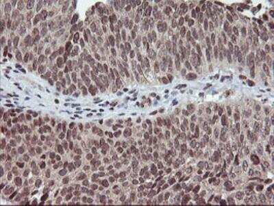 Immunohistochemistry-Paraffin: Tryptase gamma-1/TPSG1 Antibody (OTI1G1) - Azide and BSA Free [NBP2-74652] - Immunohistochemical staining of paraffin-embedded Carcinoma of Human bladder tissue using anti-TPSG1 mouse monoclonal antibody. (Heat-induced epitope retrieval by 10mM citric buffer, pH6.0, 100C for 10min, NBP2-01679).