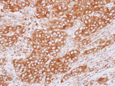 Immunohistochemistry-Paraffin: Tubulin Beta 2C Antibody [NBP2-14887] - Paraffin-embedded Breast ca, using antibody at 1:500 dilution.