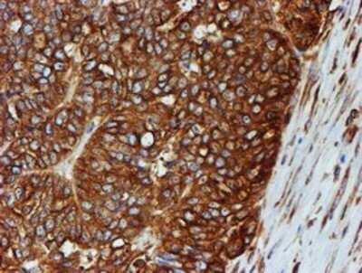 Immunohistochemistry: Tubulin Beta 4 Antibody (OTI3F1) - Azide and BSA Free [NBP2-74713] - Staining of paraffin-embedded Adenocarcinoma of Human ovary tissue using anti-Tubulin Beta 4 mouse monoclonal antibody.