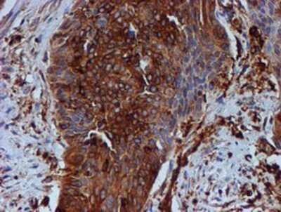 Immunohistochemistry: Tubulin Beta 4 Antibody (OTI3F1) - Azide and BSA Free [NBP2-74713] - Staining of paraffin-embedded Carcinoma of Human bladder tissue using anti-Tubulin Beta 4 mouse monoclonal antibody.