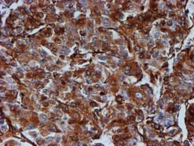 Immunohistochemistry: Tubulin Beta 4 Antibody (OTI3F1) - Azide and BSA Free [NBP2-74713] - Staining of paraffin-embedded Carcinoma of Human liver tissue using anti-Tubulin Beta 4 mouse monoclonal antibody.