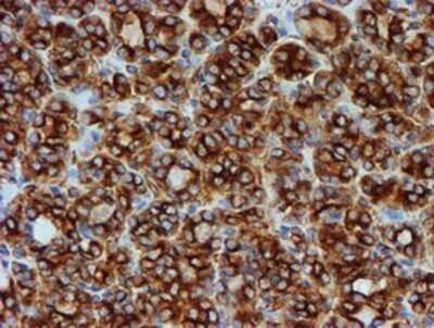 Immunohistochemistry: Tubulin Beta 4 Antibody (OTI3F1) - Azide and BSA Free [NBP2-74713] - Staining of paraffin-embedded Carcinoma of Human thyroid tissue using anti-Tubulin Beta 4 mouse monoclonal antibody.