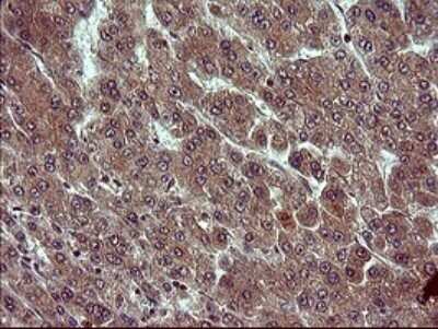 Immunohistochemistry: Tubulin alpha-1B Antibody (OTI3G3) - Azide and BSA Free [NBP2-74703] - Analysis of Carcinoma of Human liver tissue.